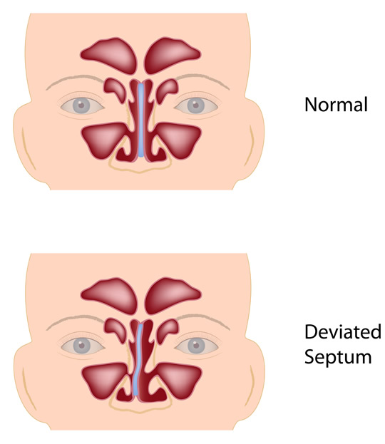 deviated Septum