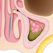sinuplasty-surgery-step1