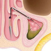 sinuplasty-surgery-step2