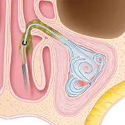sinuplasty-surgery-step3