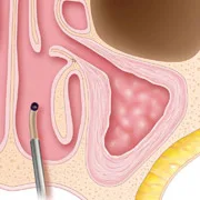 sinuplasty-surgery-step4